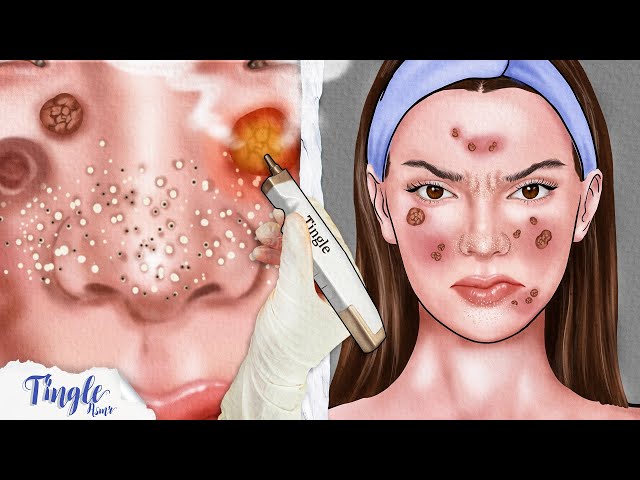 🔴 [LIVE] ASMR RELAXING ACNE REMOVAL ANIMATION VIDEO | Stop Motion | Tingle Trick